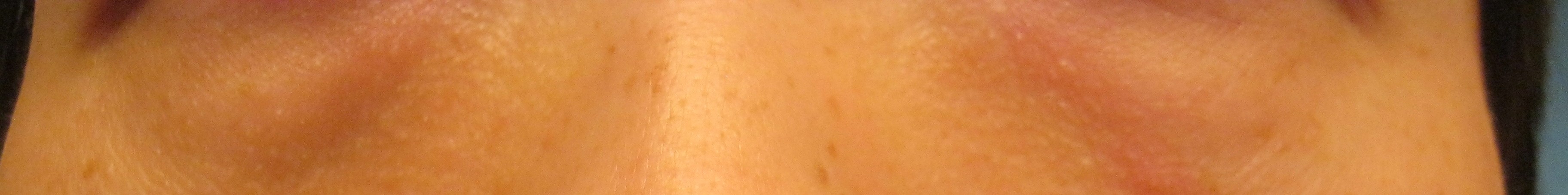 periorbital edema 2